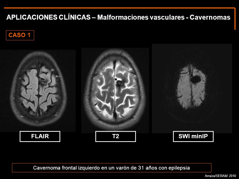 ¿La fisioterapia es buena para el dolor de la ciática?